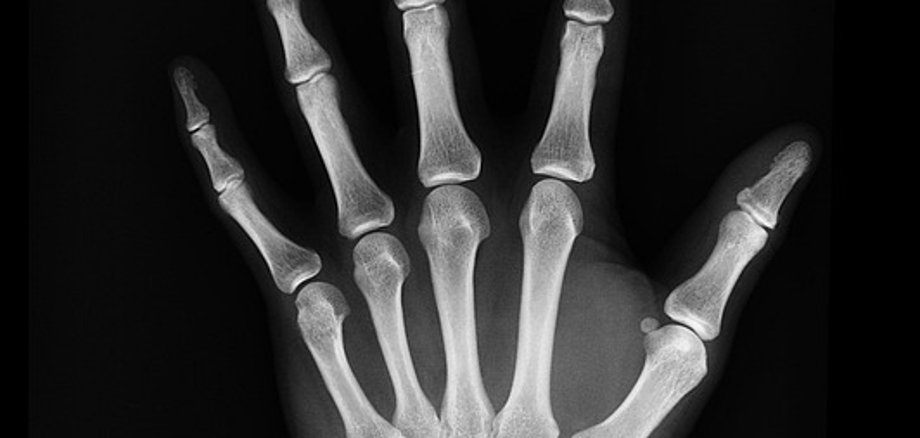 Röntgenbild von  einer Hand